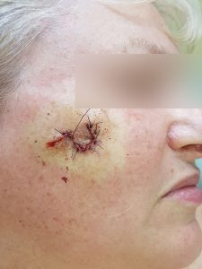 Дерматоонкология Санрайз-клиник